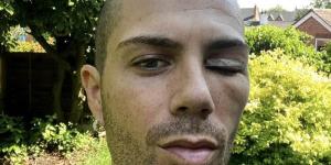 Max George leaves fans concerned after revealing painful bruised and swollen eye