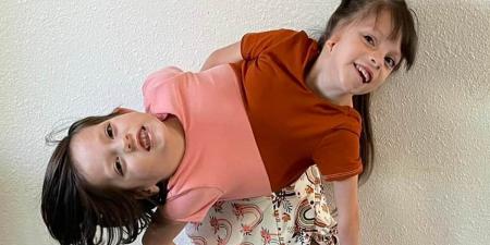 Parents of conjoined twins who were given less than 24 HOURS to live admit they were going to ABORT their babies after learning of their condition - as they reveal how girls are now defying doctors and thriving at age seven