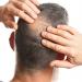 Hair transplant doctor reveals how thinning tresses leave even the most macho men hiding their heads under a hat - and even fleeing dates out of insecurity